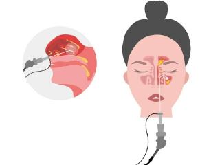 鼻窦炎伴鼻息肉是不是一定要做手术？司普奇拜单抗实现精准治疗，持续强效
