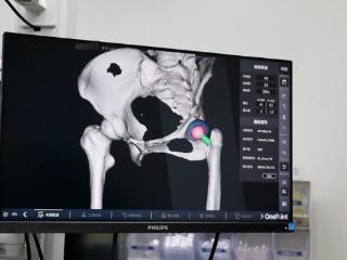 济南关节外科医院以VTS骨科机器人助先髋高脱患者成功置换