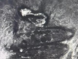 男童频繁揉眼80多只螨虫在眼里做窝：眼睑鼓起黄豆大小肿块