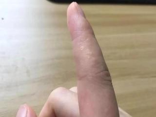 宁阳县第一人民医院：“小水泡”又痒又疼，可能是汗疱疹“作怪”