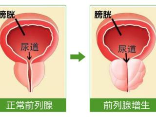 云南前列腺增生案例：大理老人10年前列腺增生 瑞梦5分钟解决