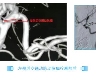 泰安市第一人民医院：微创“拆弹”，介入栓塞精准“封堵”颅内动脉瘤破口