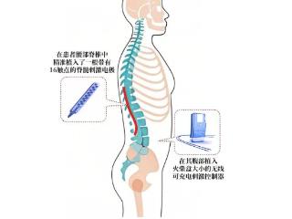 重大技术突破！全国首例，就在杭州