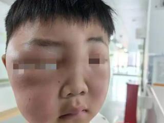男孩一觉醒来脸肿成“发面馒头”：被蚊虫叮的面目全非