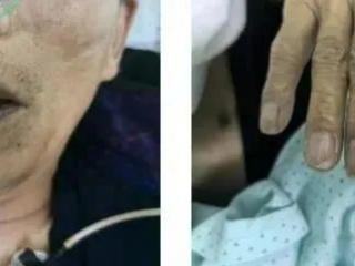 一碗下肚，中毒变“紫”了！这道菜很多人爱吃……