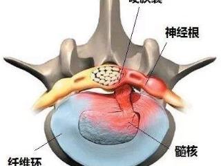 青少年腰椎间盘突出症：被忽视的“青春痛”