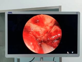 4*3cm“精准清淤”！北京大学人民医院青岛医院神经外科内镜微创技术成功救治硬膜外血肿患者