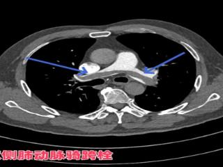 警惕！下肢肌间静脉血栓——隐匿“杀手”可致致命肺栓塞
